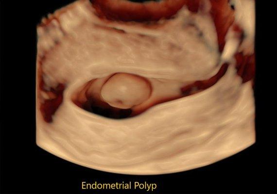 3D Saline Infused Sonohysterogram