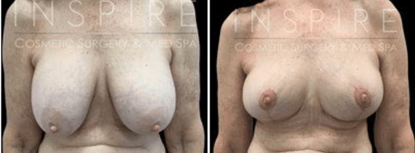 Breast Reduction/Lift Before & After