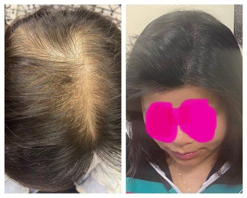 Hair Loss is devastating for women, but permanent concealment is life-changing