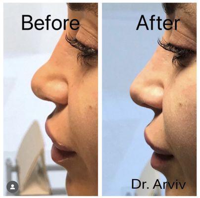 Liquid nose correction with filler