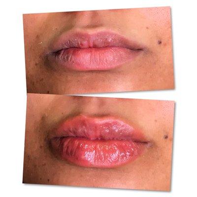 Needleless Lip Fillers