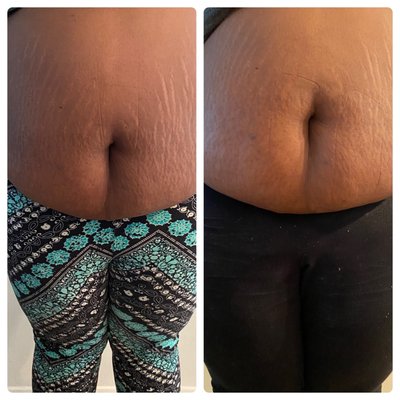 Before and After 1st cavitation treatment!