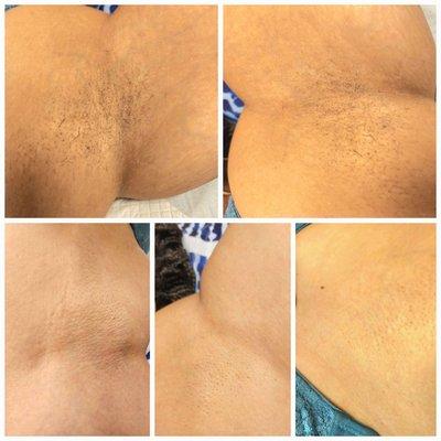 LBB'S Full smooth Underarms wax.Smooth and bright.