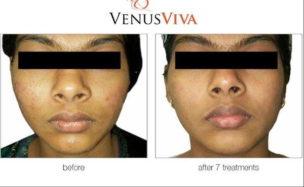 Do you have acne, acne scar, injury scars, un even skin? Try our Venus Viva treatment!! 

Call now for an appointment