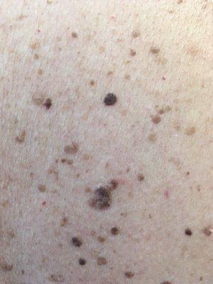 Removing Keratosis, moles, skin tags, & red cherrys on skin