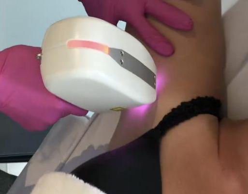 Laser hair removal