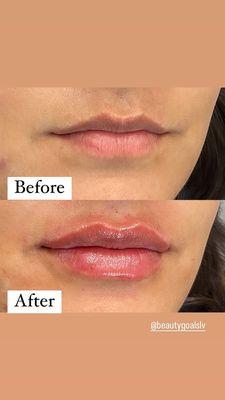 Lip filler