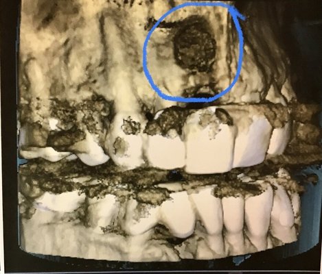 Procedure damage during front crown