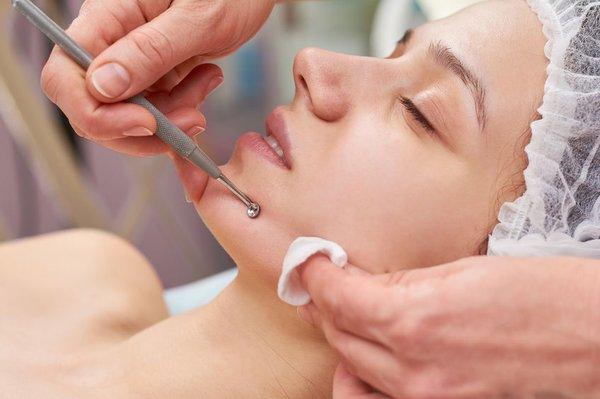 Acne Facial