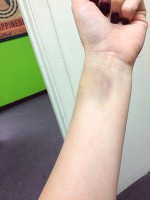 Both arms were bruised