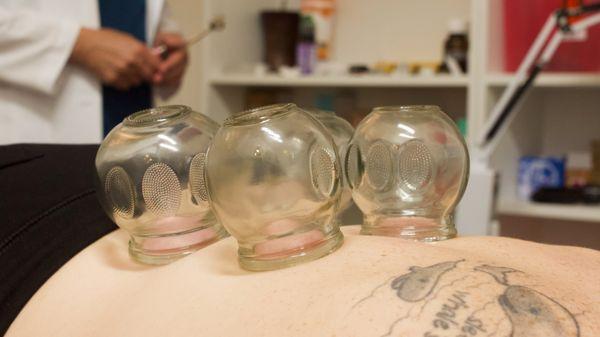 Cupping