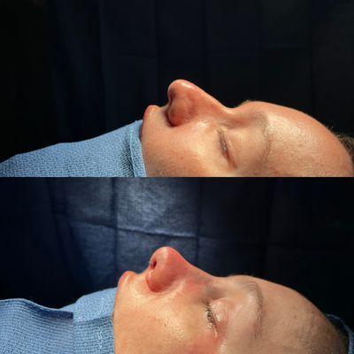 Rhinoplasty