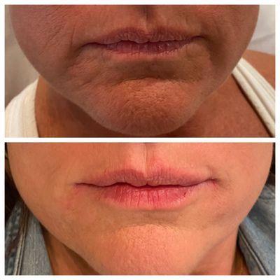 Lip filler with Restalyn Refyne.