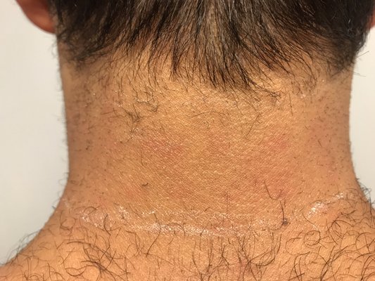 Men's Laser neck hair removal