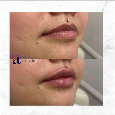 Before and After Kysse Filler