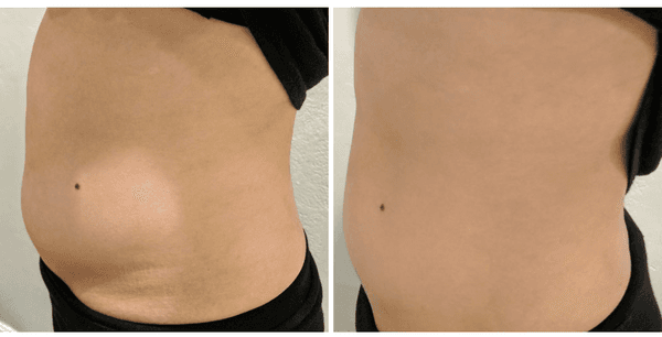 Before and Immediate After Stomach Treatment! Results continue to improve up to 1 year!