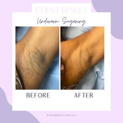 Underarm Sugaring: Before & After!