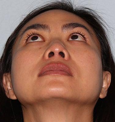 Rhinoplasty After