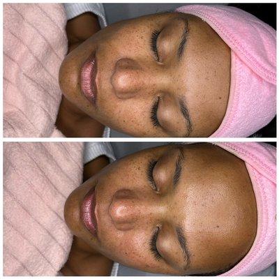 Microdermabrasion facial. Before & after. Look at that GLOW