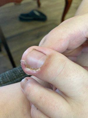 His infected toe.