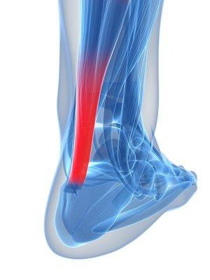 Achilles tendonitis often begins with mild pain after exercise or running that gradually worsens...