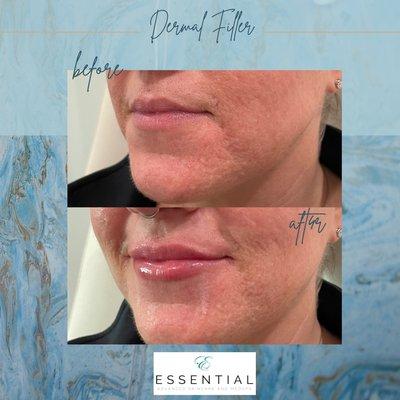 Injectable filler to subtly enhance the lips.