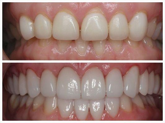 Cosmetic Veneers