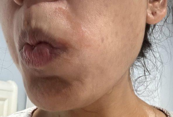 Burn over right side lip and skin