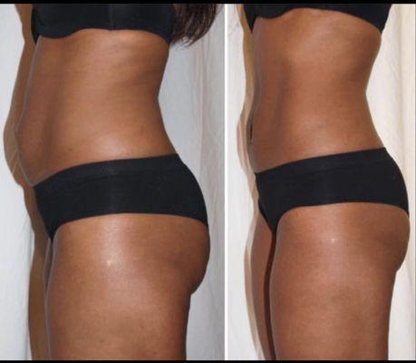 Body Contouring