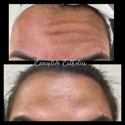 Before and After Xeomin to Relax Dynamic Wrinkles