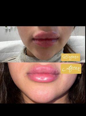 Lips correction before and after