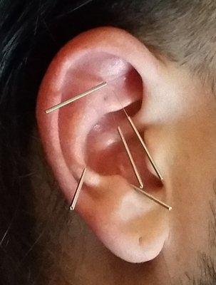 Auricular acupuncture has enormous benefits for smoking cessation and other detox therapies.