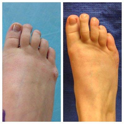 tailor's bunion deformity