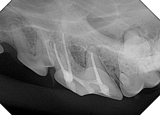 Root Canal Therapy on a 4th premolar