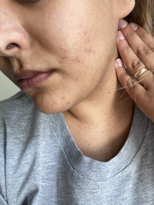 This is after 4 months of acne treatments!