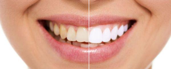 Luxury Bright White Smile Before And After Photo.