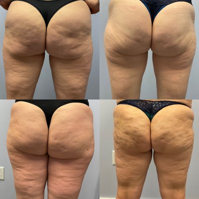 3 weeks after 1st round of QWO treatment for cellulite. Incredible improvements.