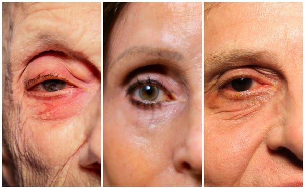 Glaucoma doesn't have to look like this Fat loss, droopy eyelids, and dark circles are all side effects of the most common glaucoma drops.