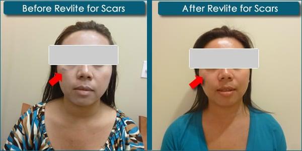 Before and After Photos of Scar Removal using Revlite