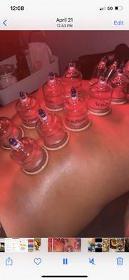 Cupping therapeutic sessions