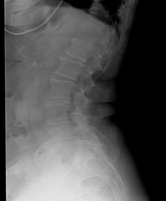 Patient with lower back pain.