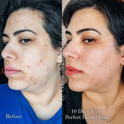 Perfect Derma Peel for acne and hyperpigmentation.