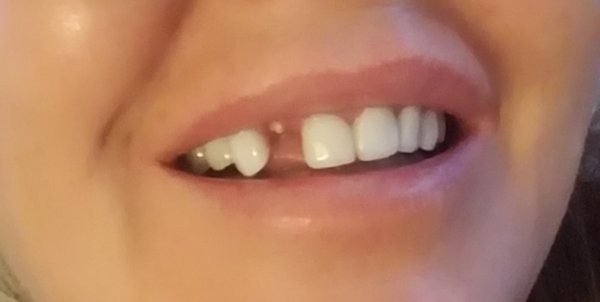 4 days later I lost the tooth.