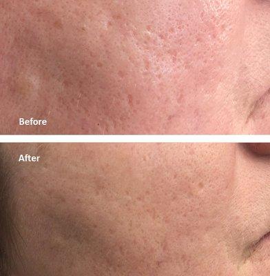 Laser Acne Scar Removal- 1 Session