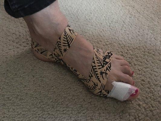 Bunion Taping