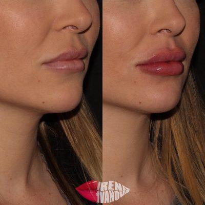 Before and after done by nurse injector, Irena. Restylane Defyne filler was used for this lip augmentation.