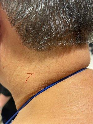 Right under the hair line you can see a whole lot of hair that was missed. Where the arrow is you can see long hairs.