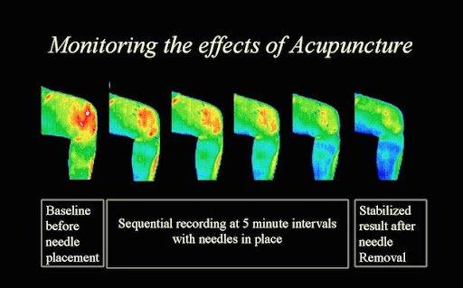 Acupuncture effects on knee pain of Thermo photo