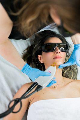 Chin ( facial area ) laser hair removal with Candela.