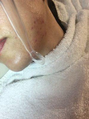 Acne Facial